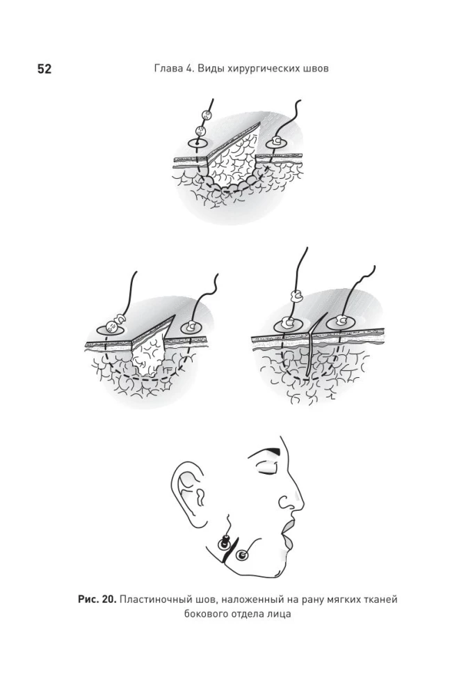 Surgical Suture