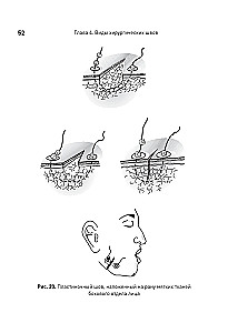 Surgical Suture