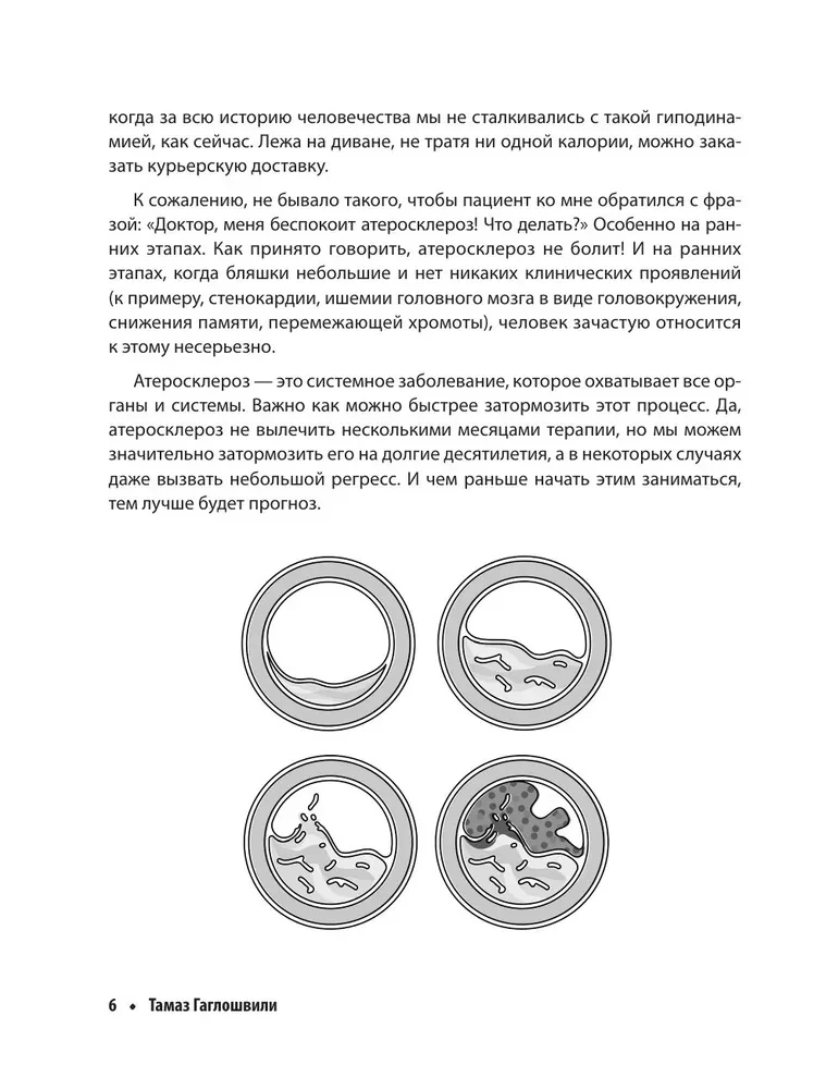 Atherosclerosis. All about treatment, diet, and maintaining vascular health